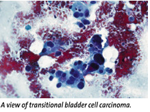 Bladder cell carcinoma photo